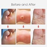 MQUPIN Corn Remover Pads 24 Pcs Foot Corn Plaster with Hole view 4