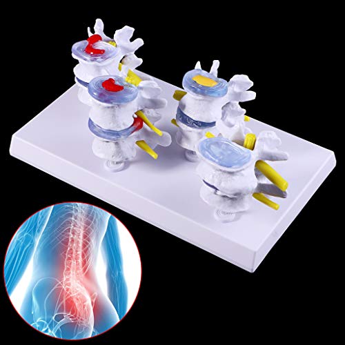Abicial 1 Set Human Lumbar Lesion Spine Statue Display Model Medical Teaching Learning Tool