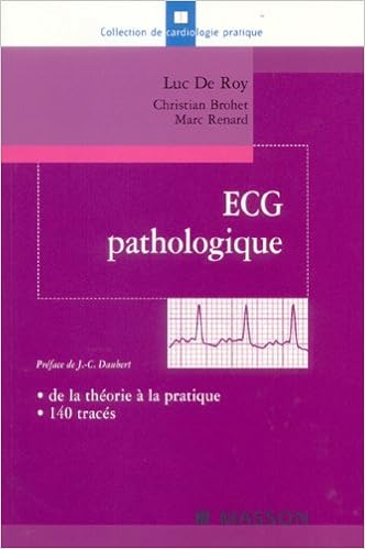 Résultat de recherche d'images pour "ECG PATHOLOGIQUE amazon"