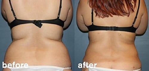 Home Use Lipo Laser - Fat Melting Machine - 6 pads