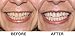 Dr. Brody's Premium Teeth Whitening System, Made Fresh in the USA, Dentist Approved! 14 Treatments