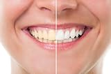 Extra Strength Teeth Whitening Kit w/ Refills