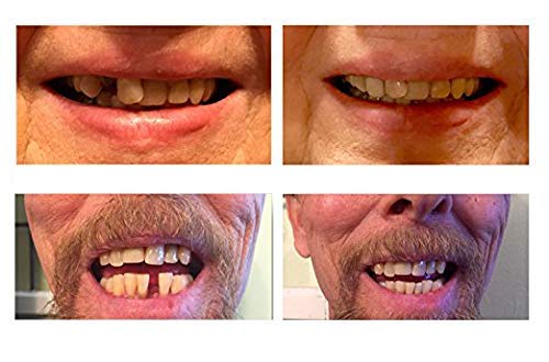 4 Amazing+Temporary+Tooth+Complete+Replacement