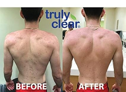 truly clear acne bar