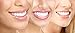 SparkleBrite - 1st Class Edition - Professional 3D At Home Teeth Whitening Kit - Let your Smile Sparkle Again!
