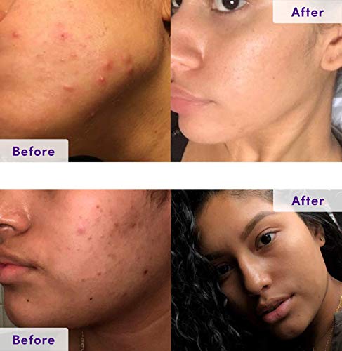 3 Treatment+Probiotics+Multi+Fruit+Salicylic+Blemishes