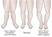LAMINET Posture Corrective Heel Cups - Large - Fits Women's Shoe Size 8.5-11 / Fits Men's Shoe Size 7-13