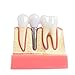 Annhua 4 Times Dental Implant Teeth Model Analysis Crown Bridge Demonstration Model, Dental Teeth Crown Roots Removable for Education, Patients Communication, Learning and Lab