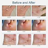 MQUPIN Corn Remover Pads 24 Pcs Foot Corn Plaster with Hole view 2