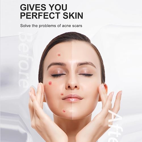 BOSISI Repair Acne Cream,Acne Removal Cream, Pimple Treatment Cream