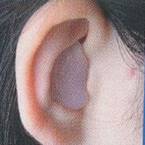 丸めたインスタパティを耳入り口部へ