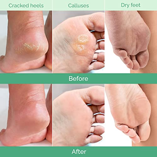 Plantifique Foot Peel Mask – 2 Pairs Exfoliating & Dermatologically Tested Foot Treatment, Removes Dead Skin & Repairs Heels for Soft Feet – Peach Scent, Gift for Women & Men