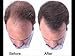 Hair Building Keratin Fibers - Conceal Hair Loss, Add Thickness and Body, and Thicken Thinning Roots - for Men and Women by Beverly Hills (Dark Brown)