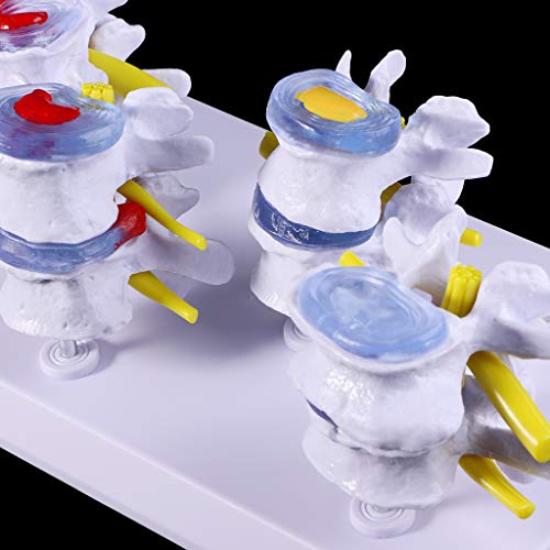 Abicial 1 Set Human Lumbar Lesion Spine Statue Display Model Medical Teaching Learning Tool