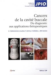 Les  cancers de la cavité buccale