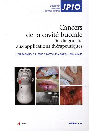 Les  cancers de la cavité buccale