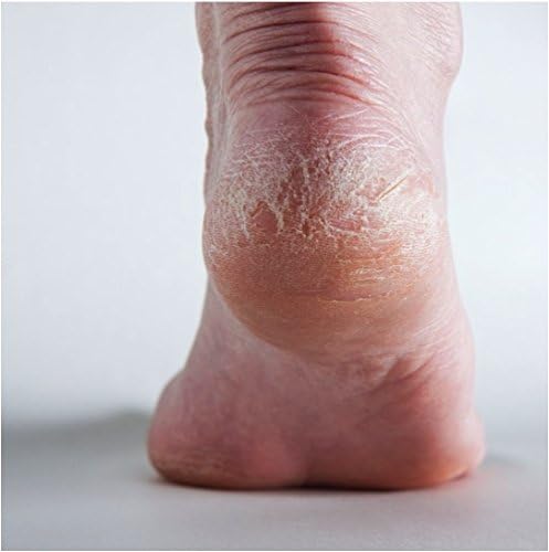 |Launch Release Massive Price Drop| - Intensive Foot Cream Relieves Dry Skin, Repairs Cracked Heels and Softens Feet