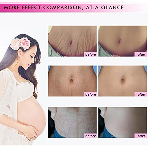 Mango Stretch Marks and Scar Cream, Stretch Mark and Scar Removal Cream for Pregnancy, Belly Creams for Wrinkles, Obesity Fat Marks Scars Moisturizing, Remove Marks (40g)