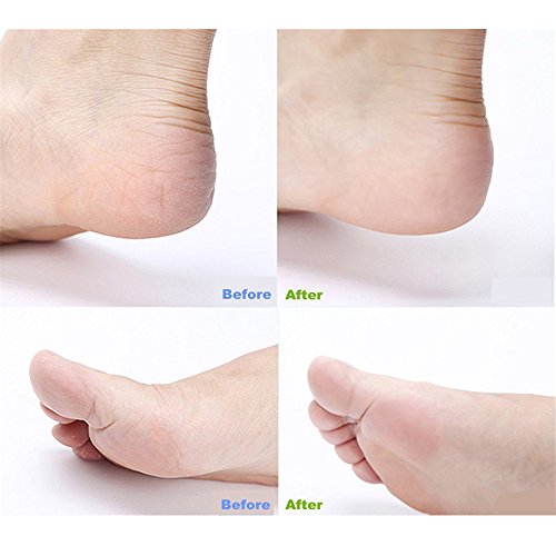 Pretty See Pedicure Rasp Foot File Callus Remover for Removing Hard Skins and Cracked Skin Corns, Foot Exfoliating Scrubber Cleaner File 3 Pcs/Set