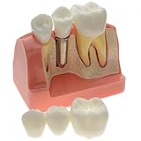 Enshey Dental Implant Analysis Dental Demonstration Teeth Model Crown Bridge Demonstration Teeth 2017