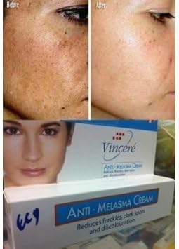 vin21 anti acne cream