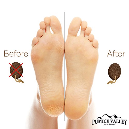Pumice Stone for Feet - Natural Lava Foot Stone with New Eco-Friendly Holder - Callus Warts Corn Removal - Pedicure Exfoliator for Dry Dead Skin, Heels, Elbows, Hands - Healthy Foot Care Scrubber - Thumbnail 6