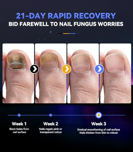 Next-Gen Nail Fungus Laser Device【21-day Fast-acting】Antifungal Laser【Kaltlicht-Technologie - Wohltuend mild】 PainFree Device With Time Display & Yellow Cuticle Oil Pen