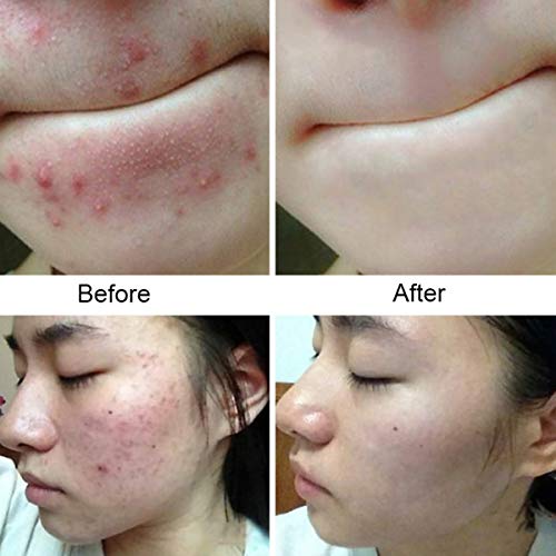 2PCS Sea Salt Soap Bars with Goat's Milk Natural,ROMANTIC BEAR Blackhead & Acne Scars Remover,Anti Cellulite Soap Deep Facial Cleaning For Natural Dry And Oily Skin - Thumbnail 4