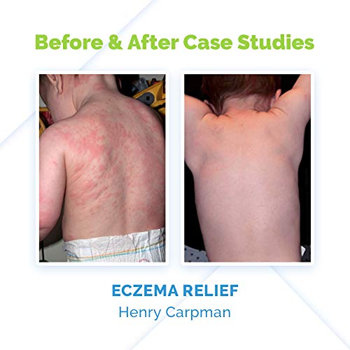 Amazon Com Skin Md Natural Shielding Lotion For The Face Body Hands 8oz Spf 15 2 Pack Helps With Eczema Psoriasis The Natural Dry Skin Remedy To The Things