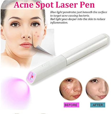 laser blackhead removal