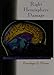 Right Hemisphere Damage: Disorders of Communication and Cognition