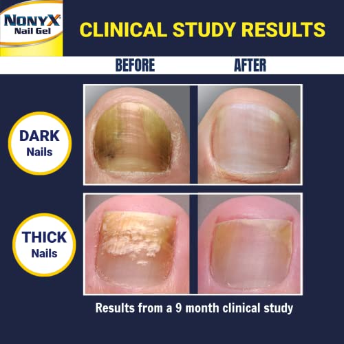 NONYX Fungal Nail Clarifying Gel Clears out Fungus by Removing