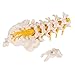 3B Scientific A76/5 Lumbar Spinal Column with Dorso-Lateral Prolapsed Intervertebral Disc, 13.4