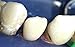 Zubastick Zirconia Alumina Anterior Transparent Crowns Matrices Matrix 64 pcs.