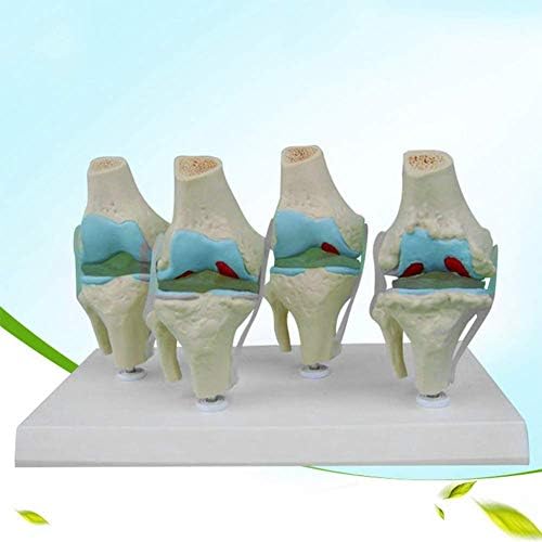 XIEJI Knee Joint-Pathology Model Life Size Human Anatomy Bone Morbid Display of Human Knee Joint with Instruction Card