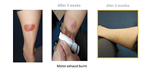 eczema wound care