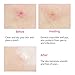 Haphome Pimple Patch, Acne Patch, Tea Tree and Calendula Oil Hydrocolloid Bandages for Acne Dots, Acne Spot Treatment Zit Patch (144 Patches, 4 Pack)