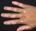 Hypopigmentation Vitiligo Support Powder Supplement 120 ml & Topical Oil 5 oz. Supports Bringing Skin Color Back