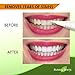 RW Teeth Whitening Professional Home Kit - Hydrogen Peroxide Gel Extra Strong Formula For FAST RESULT! No LED light needed! Cheek Retractor System to Prevent Gum Sensitivity.