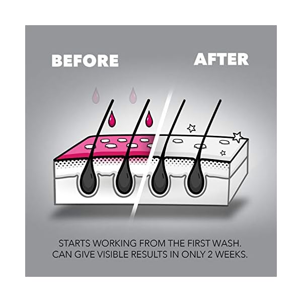 Nizoral Anti-dandruff Shampoo 60ml, clinically proven Treatment for dandruff flare ups, relieve itching, helps remove…