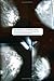 The Biopolitics of Breast Cancer: Changing Cultures of Disease and Activism