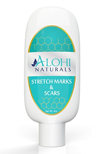 Alohi Stretch Mark Cream (4 Oz) Natural & Organic Ingredients - Coconut Oil, Rose Hip Seed Oil, Aloe Vera - Excellent Moisturizer for Sensitive Dry Skin Works on New and Old Stretch Marks