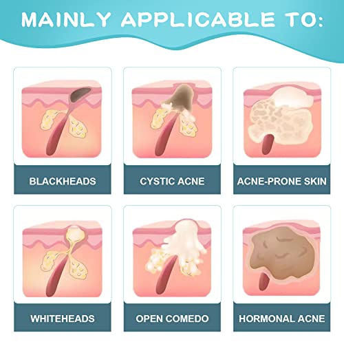 Paradise Emerald Cystic Acne Spot Treatment, Hormonal Acne Treatment