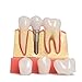 Annhua 4 Times Dental Implant Teeth Model Analysis Crown Bridge Demonstration Model, Dental Teeth Crown Roots Removable for Education, Patients Communication, Learning and Lab