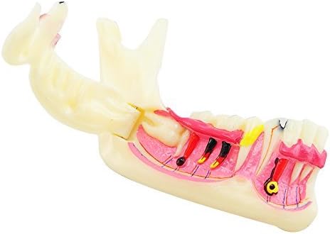Dental Teeth Model Patient Education Model Caries Detail Tooth Model