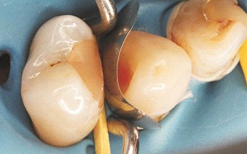 50 of Dental Sectional Contoured Matrices Matrix + 200 Wooden Wedges - Thumbnail 3