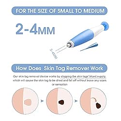 Skin Tag Remover, Skin Tag Removal Kit Tools with