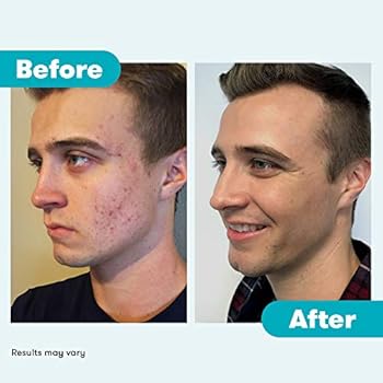 proactiv face wash amazon