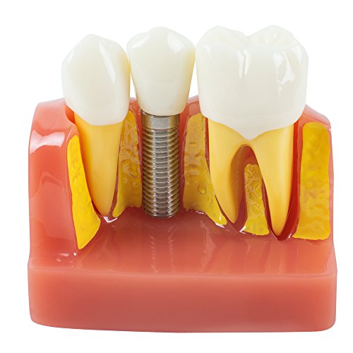 Vinmax Dental Analysis Crown Bridge Teach Equipment Demonstration Removable Teeth Model Implant