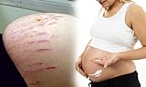 Best Cream Stretch Mark & Firming Cream During Pregnancy 100 G. x 2 Tubes
